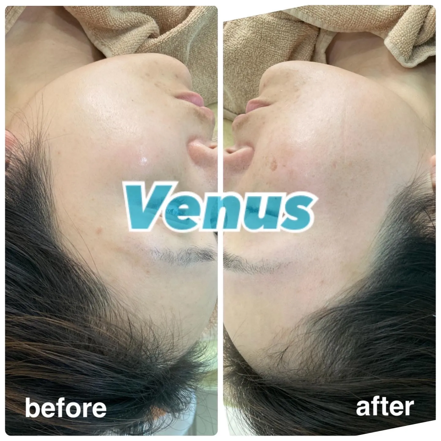 お顔/ワックス脱毛/デザイン脱毛