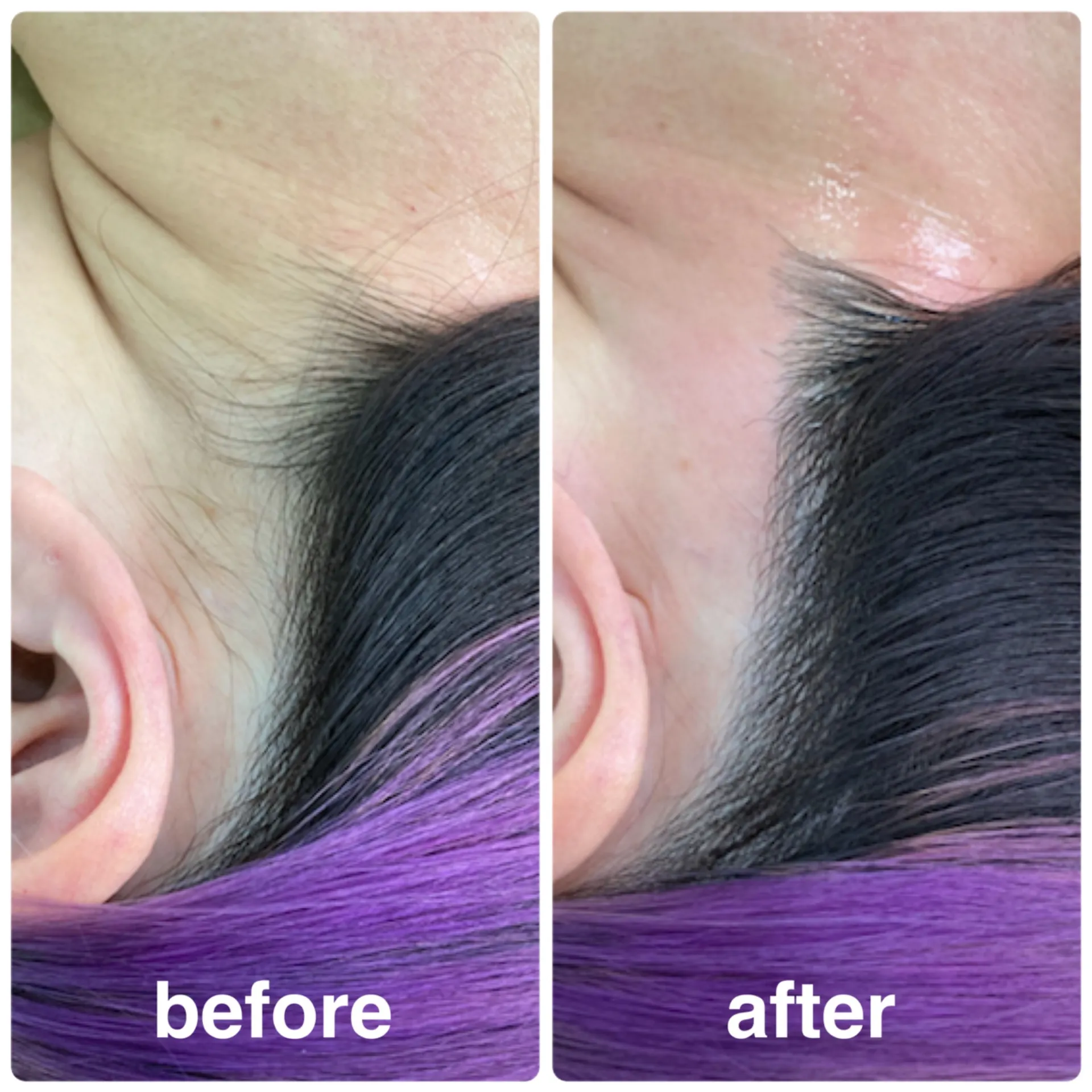 うなじ/ワックス脱毛/ミックス脱毛